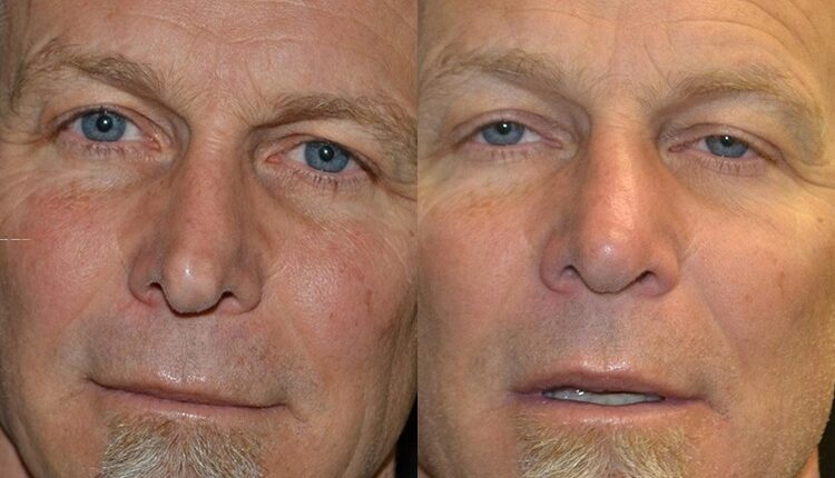 Consider Dermal Fillers