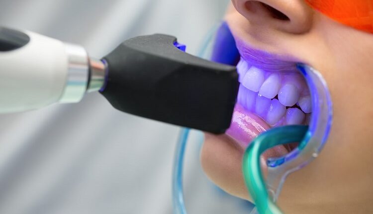 Teeth Whitening