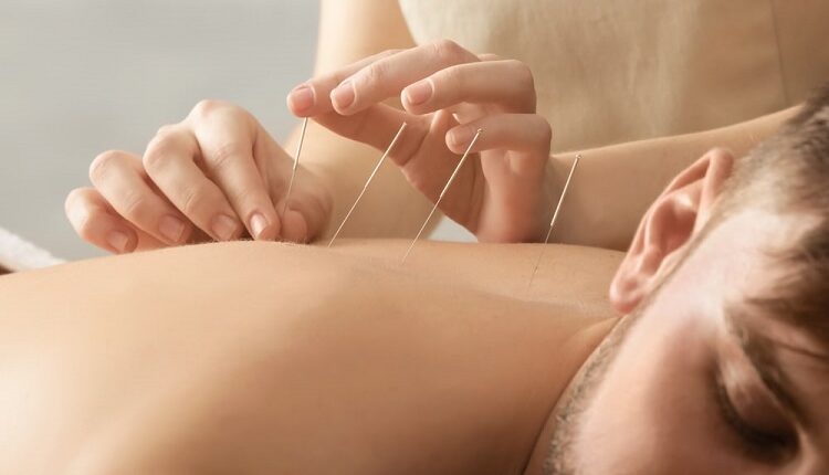 Acupuncture