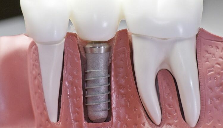 Tooth Replacement