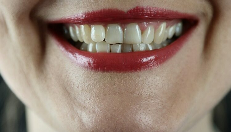 Misaligned Teeth