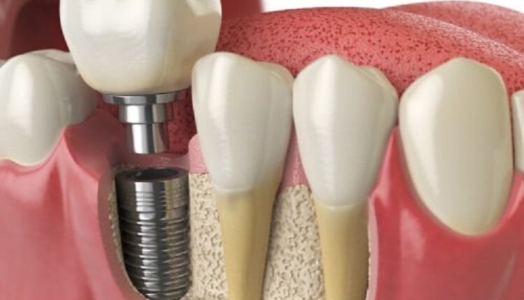 Missing Teeth