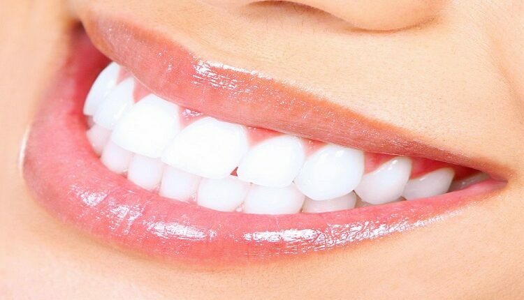 Teeth Whitening