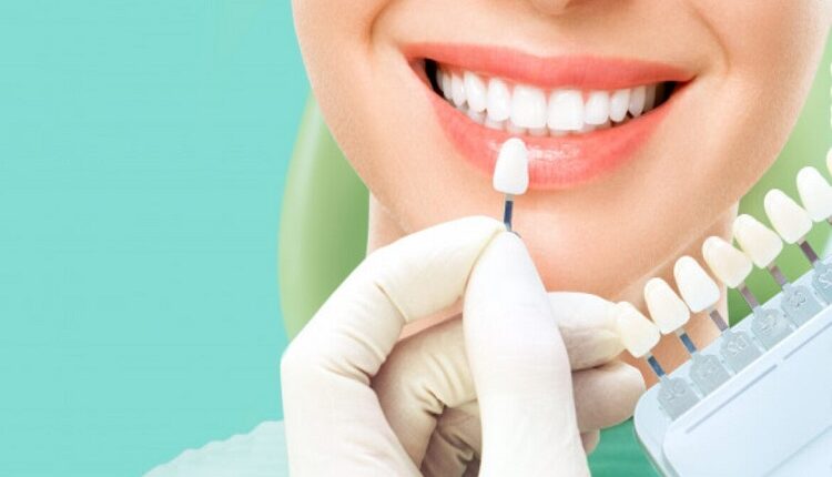 Dental Veneers