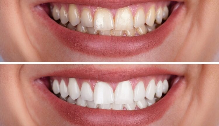 Invisalign London