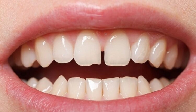 Teeth Fix